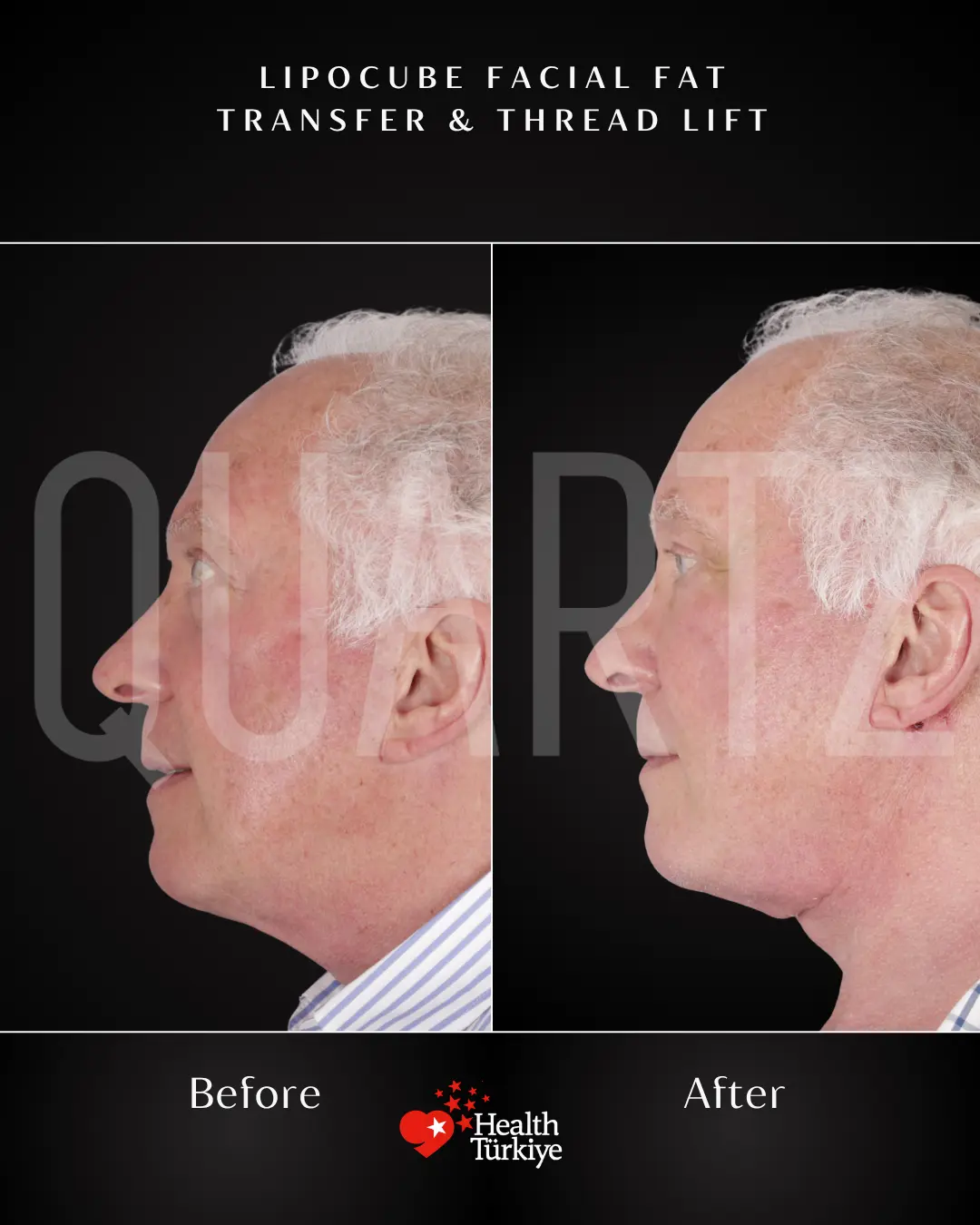 Before & After: Facial Fat Transfer New Result 4